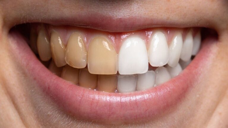 El truco casero para blanquear tus dientes rápido y fácil