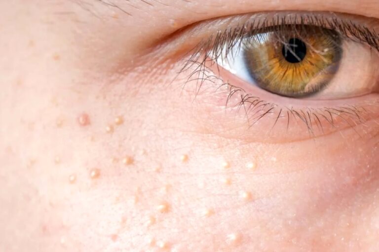 Quistes de millium: cómo eliminarlos de forma segura y prevenir su aparición en la piel