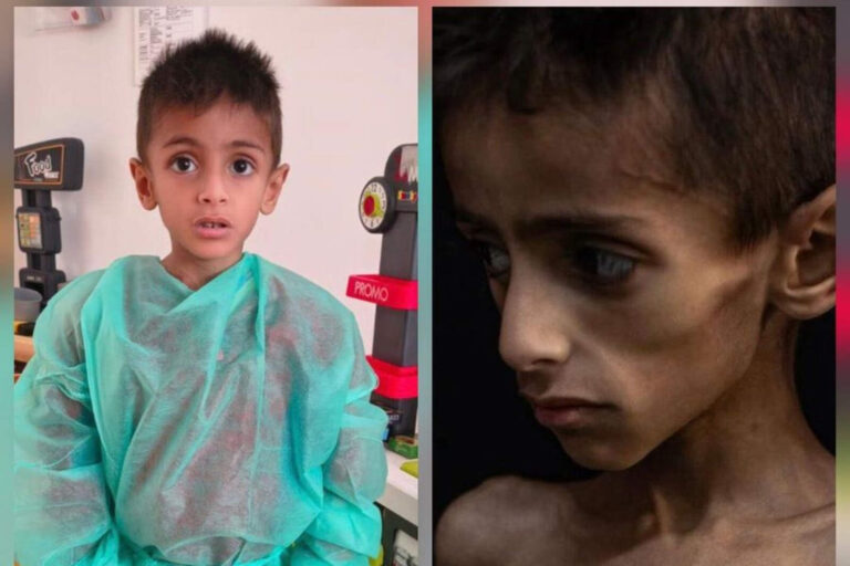 Otra falsa imagen de un niño desnutrido desnuda el aparato de propaganda de Hamas